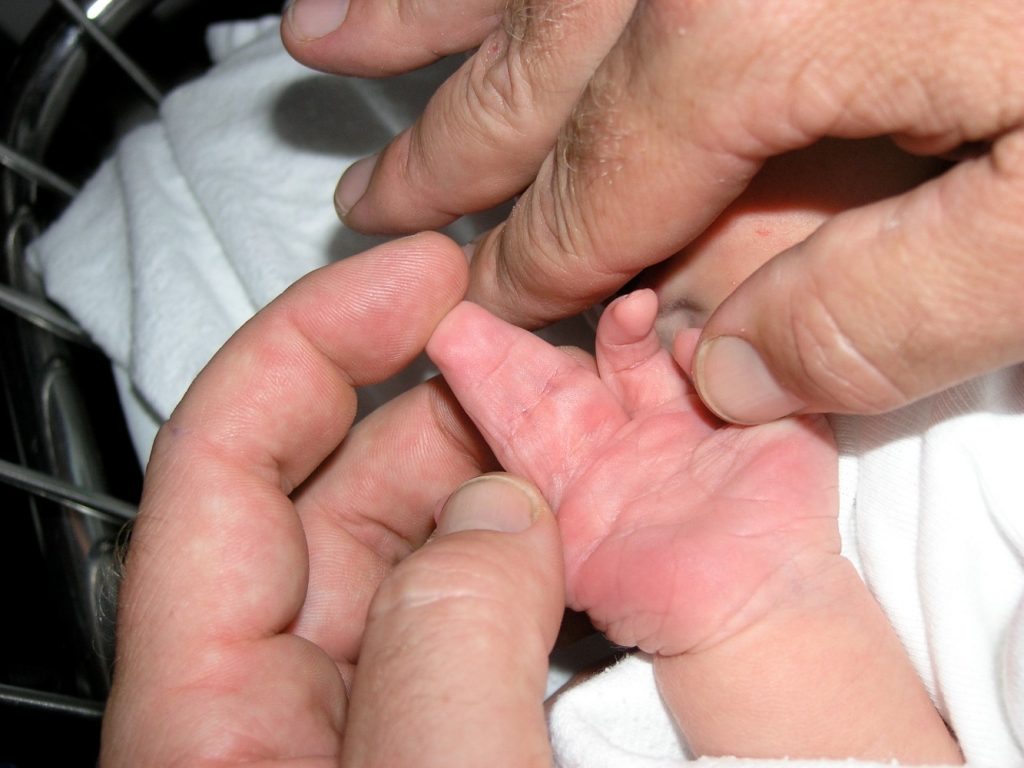 New born boy showing complete complex syndactyly with two fingers right hand Custom